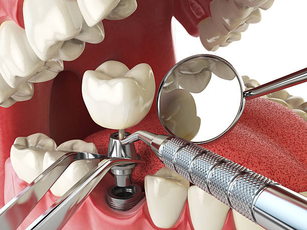 Best Emergency Root Canal Treatment in Hebron, KY